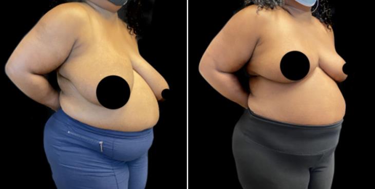 Atlanta GA Decreased Breast Size