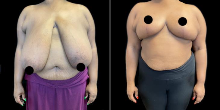 Decreased Breast Size Marietta