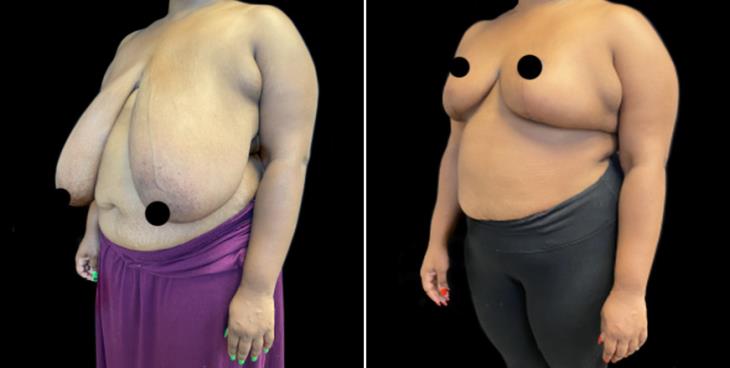Decreased Breast Size Marietta GA