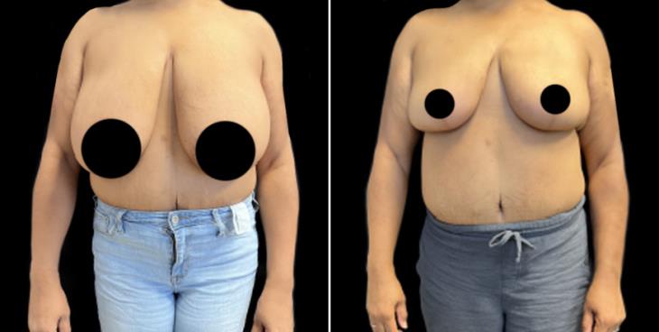 Marietta Georgia Decreased Breast Size