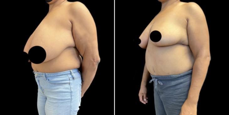 Cumming Decreased Breast Size