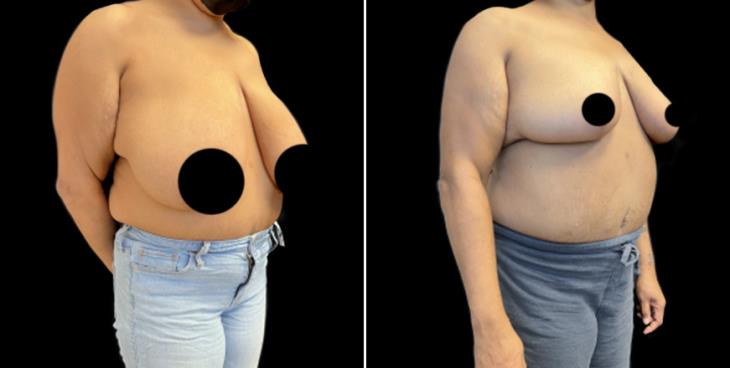 Decreased Breast Size Cumming
