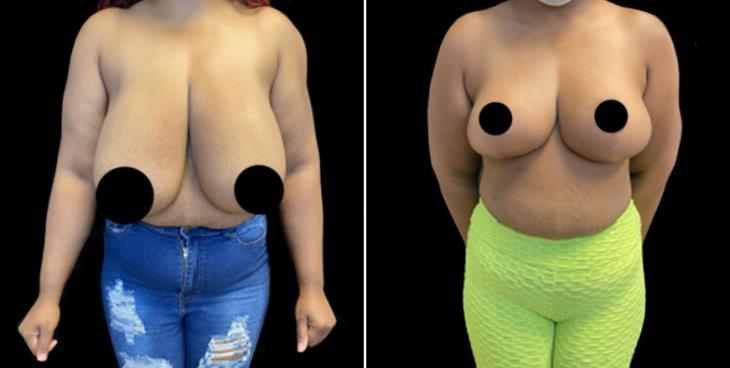 Decreased Breast Size Cumming Georgia