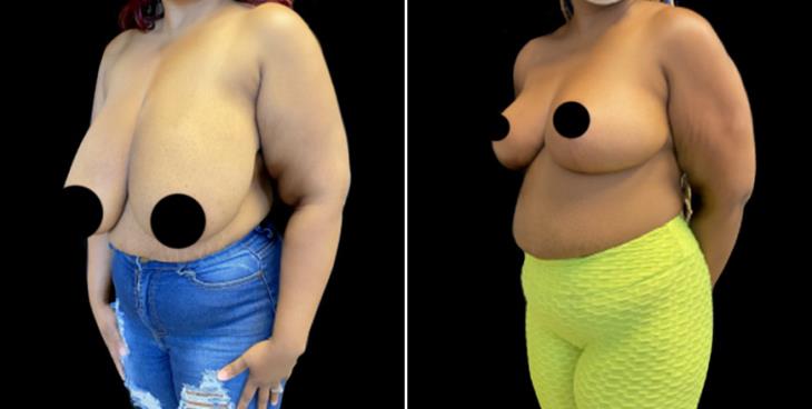 Cumming Georgia Decreased Breast Size