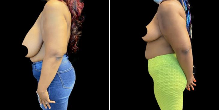 Results Of Breast Reduction Surgery In Atlanta