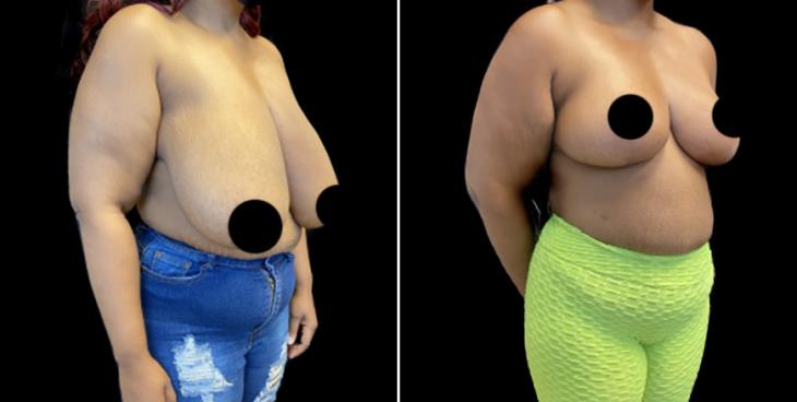 Breast Reduction Surgery Results