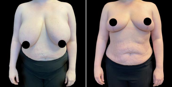 Breast Reduction Surgery Results Atlanta