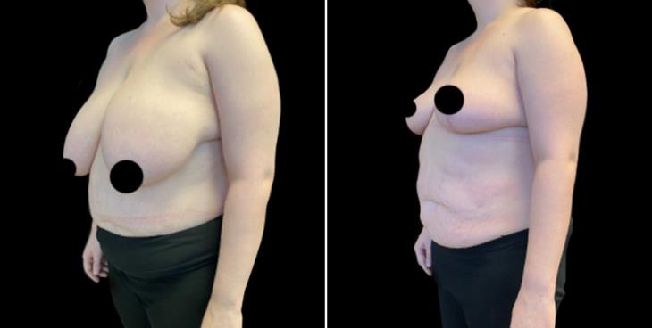 Breast Reduction Surgery Results Atlanta GA