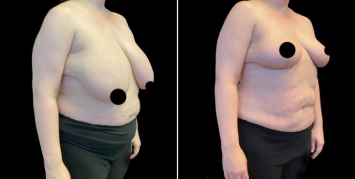 Atlanta GA Breast Reduction Surgery Results