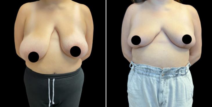 Breast Reduction Surgery Results Georgia