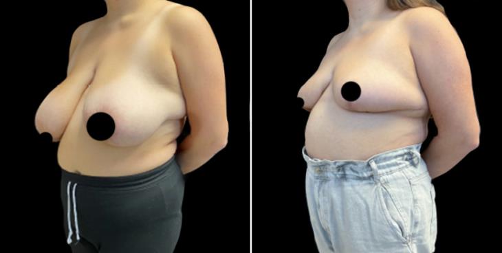 Georgia Breast Reduction Surgery Results
