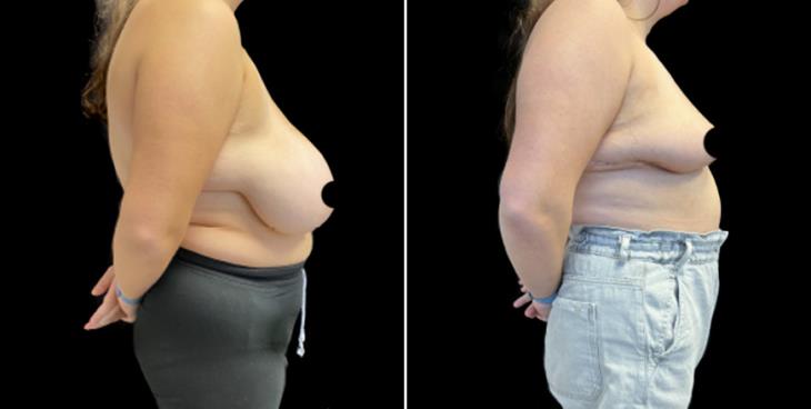 Before & After Breast Reduction Surgery Georgia