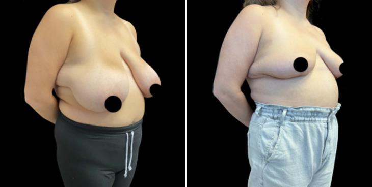 Breast Reduction Surgery Results GA