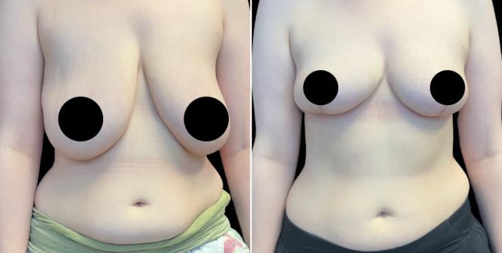 Georgia Before & After Breast Reduction Surgery