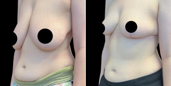 Before & After Breast Reduction Surgery GA