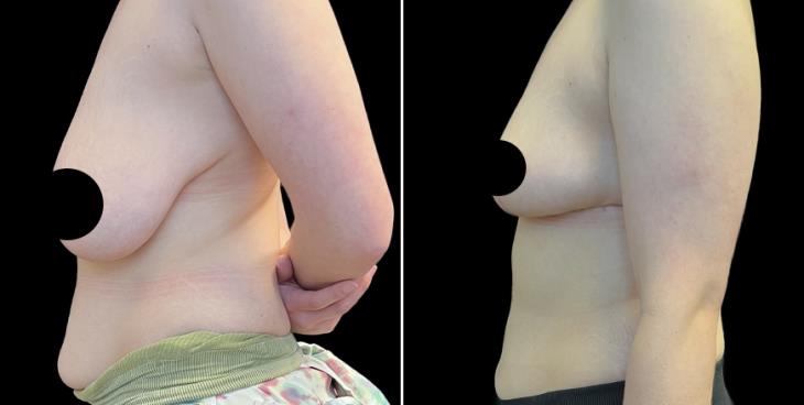 Before & After Breast Reduction Surgery Atlanta