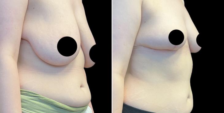 GA Before & After Breast Reduction Surgery