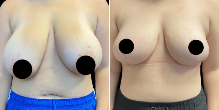 Before & After Surgery To Reduce Breasts Atlanta GA