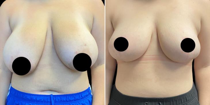 Before & After Surgery To Reduce Breasts Atlanta GA