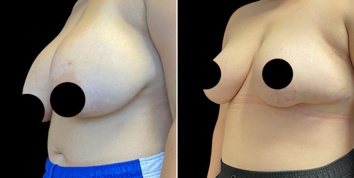 Atlanta GA Before & After Surgery To Reduce Breasts