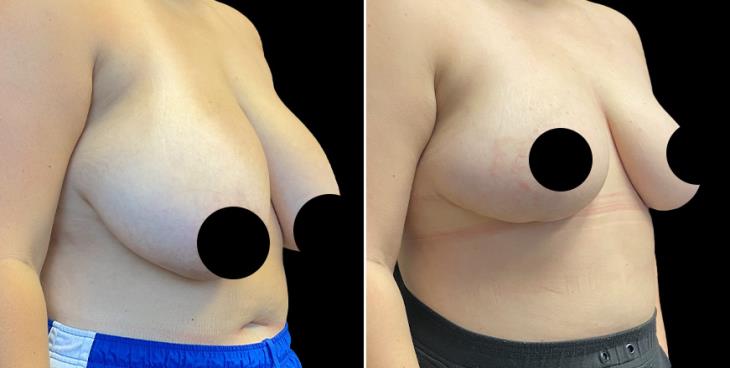 Atlanta Georgia Before & After Breast Reduction Surgery