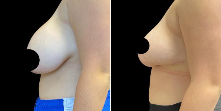 Before & After Breast Reduction Surgery Atlanta Georgia