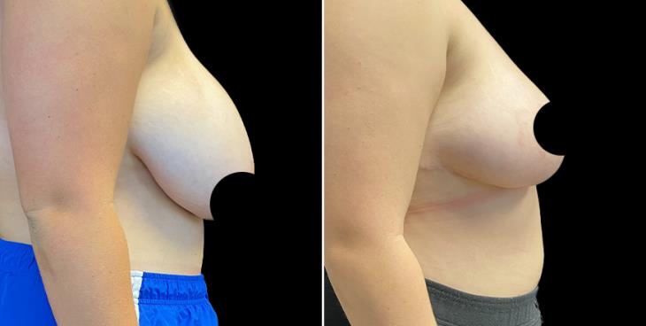Before And After Breast Reduction Surgery
