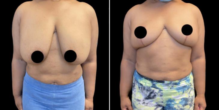 Breast Reduction Surgery Before And After