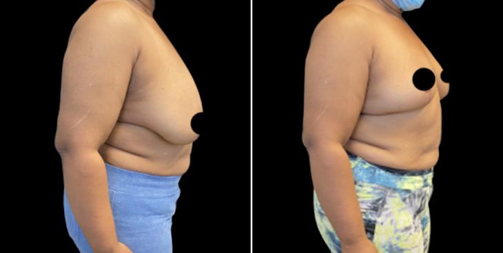 GA Before And After Breast Reduction Surgery