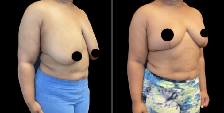 Georgia Before And After Breast Reduction Surgery