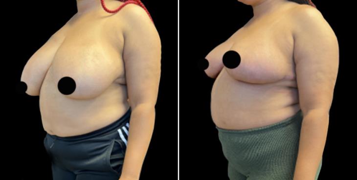 Atlanta Before And After Breast Reduction Surgery