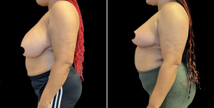 Atlanta GA Before And After Breast Reduction Surgery