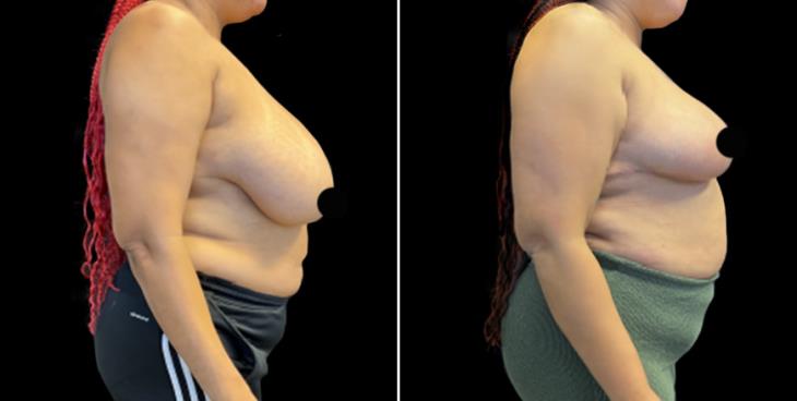 Before And After Breast Reduction Surgery Atlanta Georgia