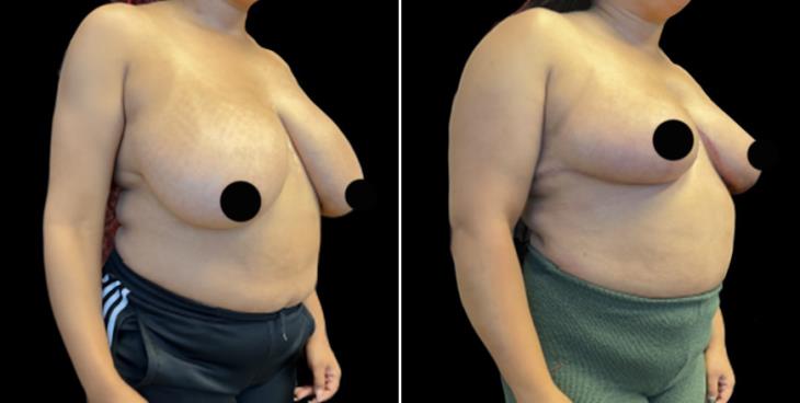Before And After Breast Reduction Surgery Atlanta GA