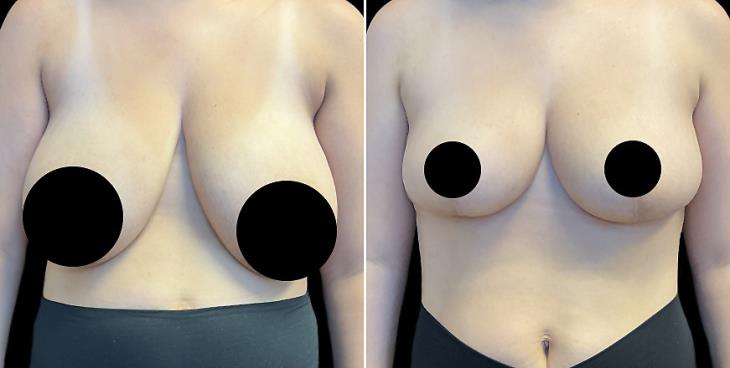 Atlanta Georgia Before And After Breast Reduction Surgery
