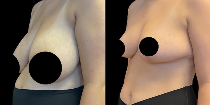 Before And After Breast Reduction Surgery Marietta