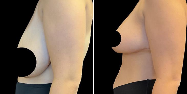Before And After Breast Reduction Surgery Marietta GA