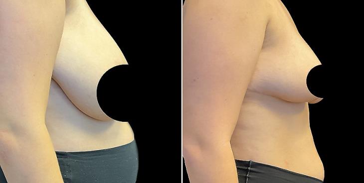 Marietta GA Before And After Breast Reduction Surgery
