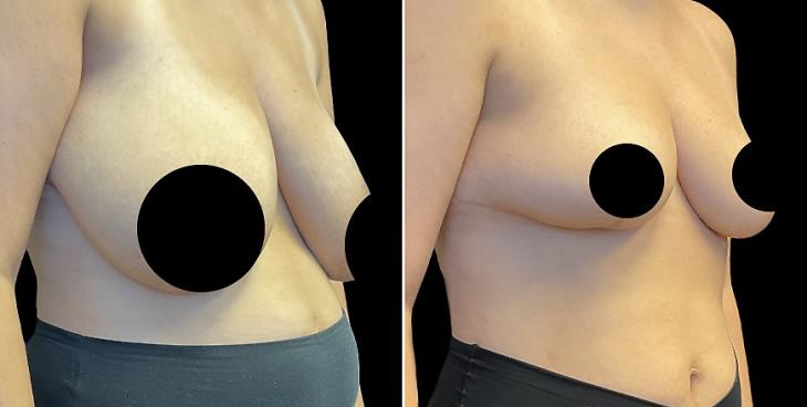 Marietta Before And After Breast Reduction Surgery