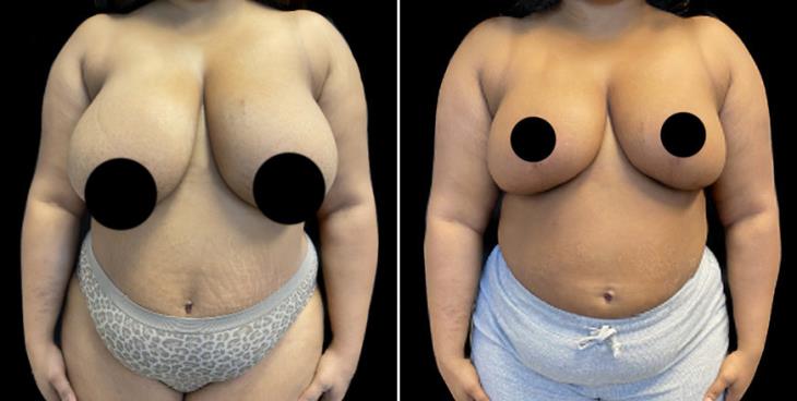 Before And After Breast Reduction Surgery Marietta Georgia