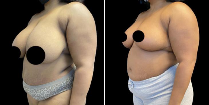 Marietta Georgia Before And After Breast Reduction Surgery