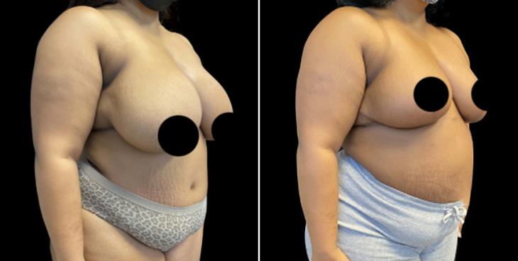 Before And After Breast Reduction Surgery Cumming
