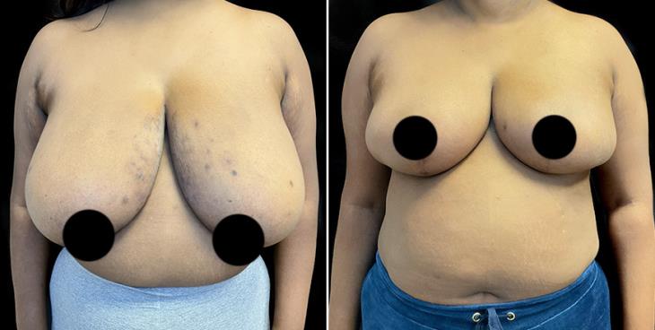Cumming GA Before And After Breast Reduction Surgery