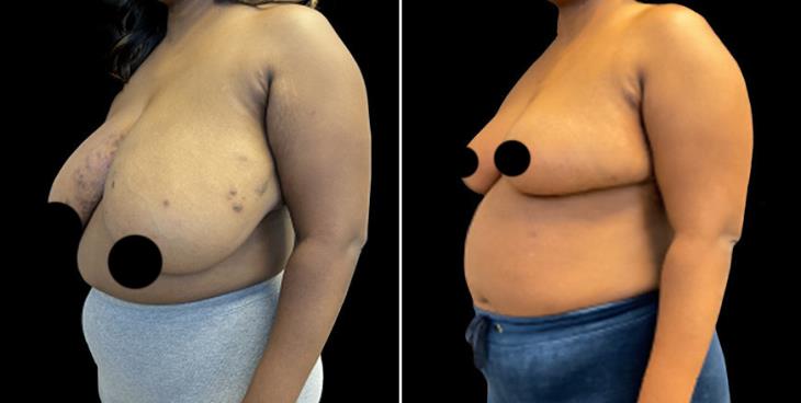 Before And After Breast Reduction Surgery Cumming Georgia