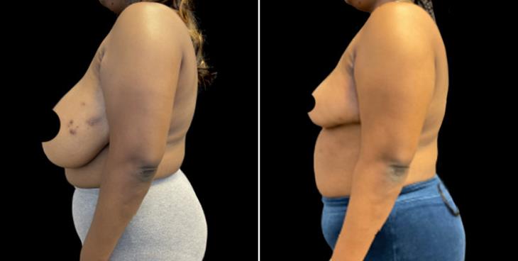 Breast Reduction Surgery Before & After