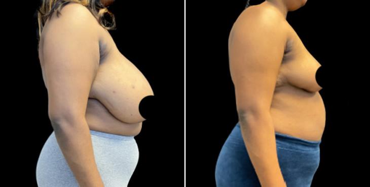 Before & After Breast Reduction Surgery