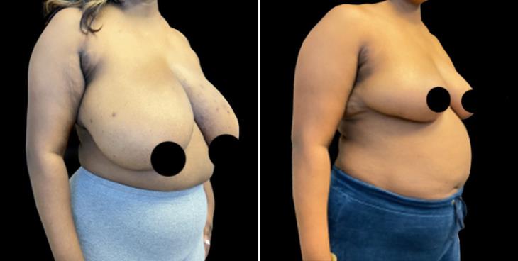 Cumming Georgia Before And After Breast Reduction Surgery