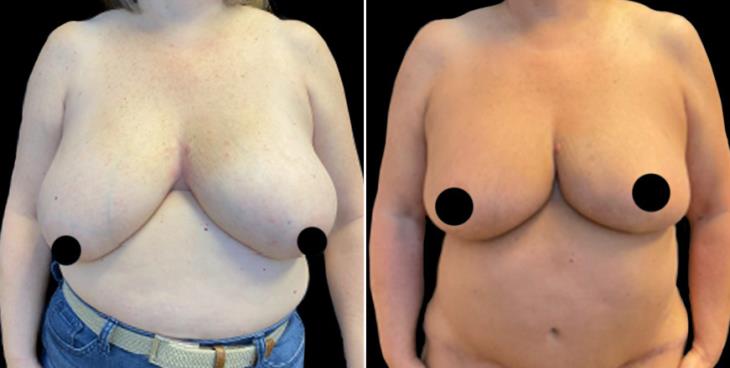 Breast Reduction Surgery Before & After Atlanta