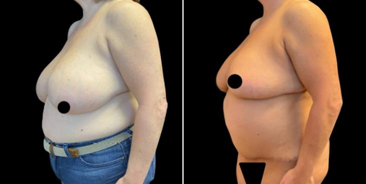 Atlanta Breast Reduction Surgery Before & After