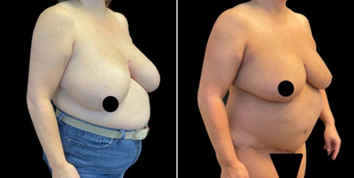 Before & After Breast Reduction Surgery Atlanta GA